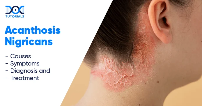 Acanthosis Nigricans