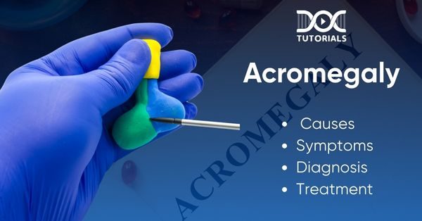Acromegaly
