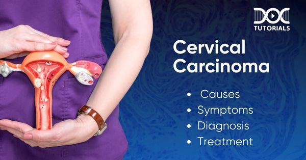 Cervical Carcinoma