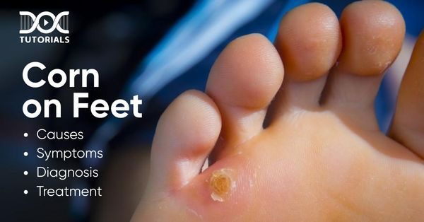 Corn on Feet