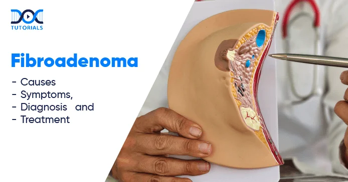 Fibroadenoma