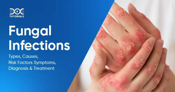 Fungal Infections
