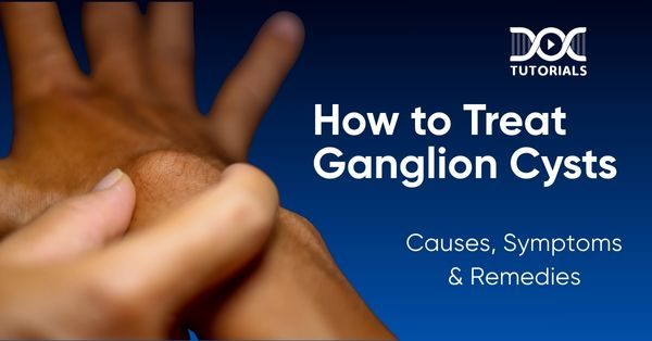 Ganglion Cysts