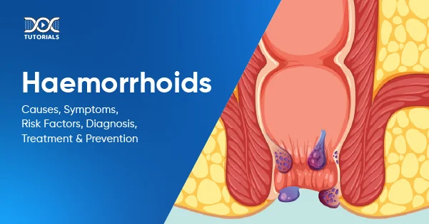 Haemorrhoids