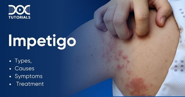 Impetigo
