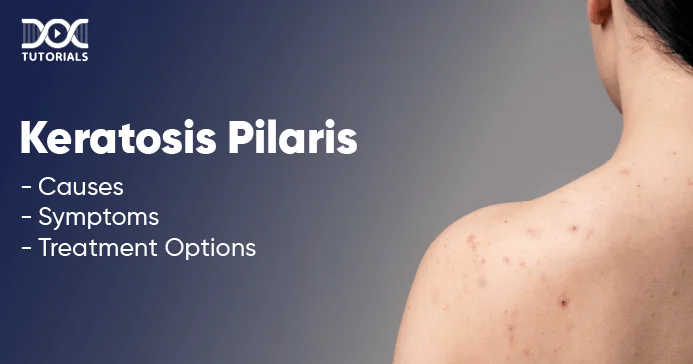 Keratosis Pilaris