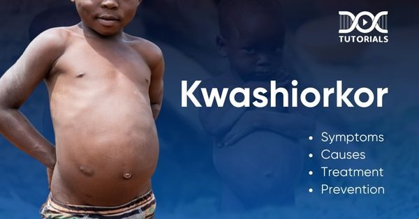 Kwashiorkor