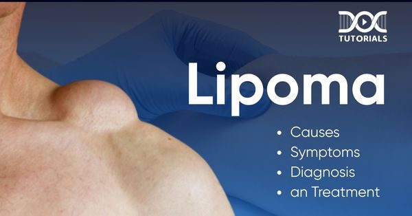 Lipoma