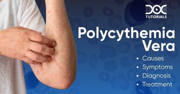 Polycythemia vera