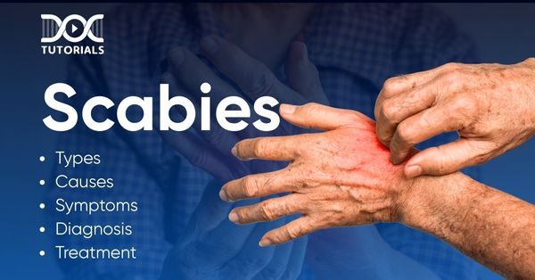 Scabies