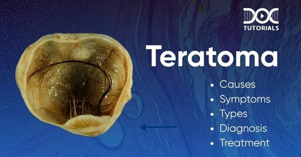 Teratoma