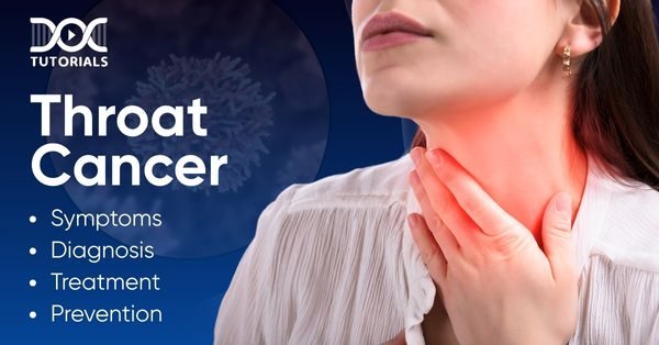 Throat cancer