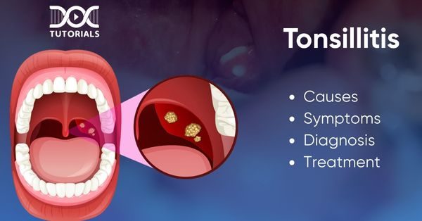 Tonsillitis