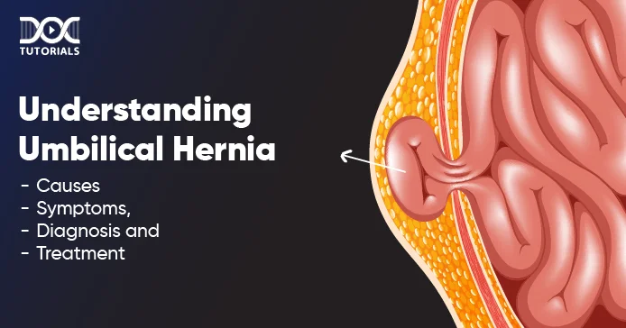 Umbilical Hernia