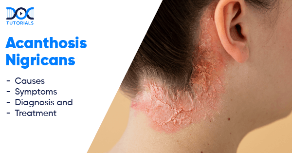 Acanthosis