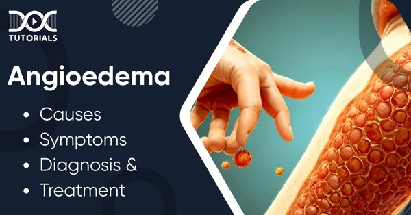 Angioedema
