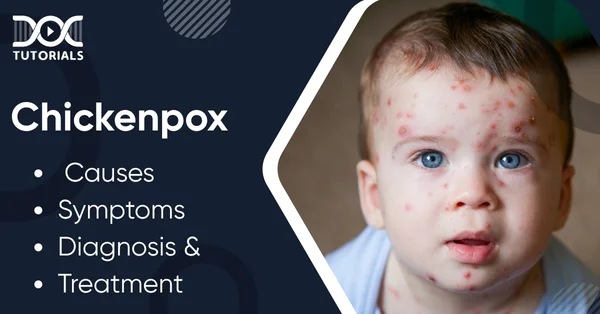 Chickenpox