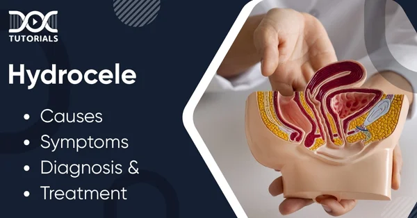 Hydrocele