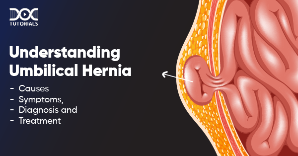 Umbilical Hernia