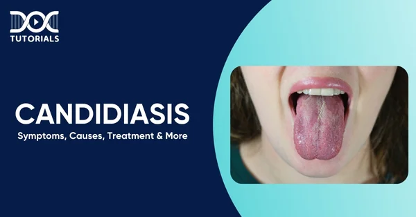 Candidiasis