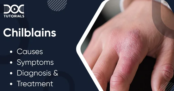 Chilblains