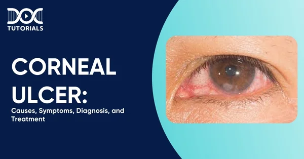 Corneal Ulcer
