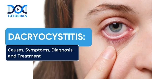 Dacryocystitis