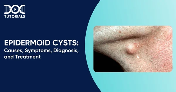 Epidermoid Cyst
