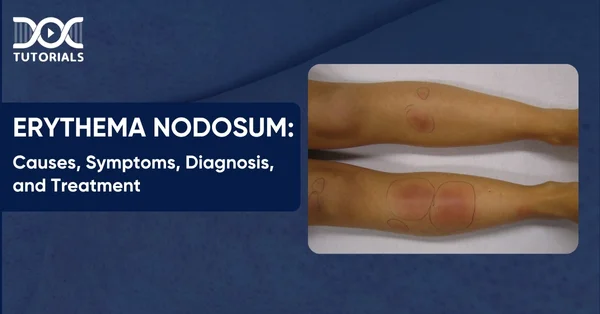 Erythema Nodosum Causes Symptoms Diagnosis Treatment