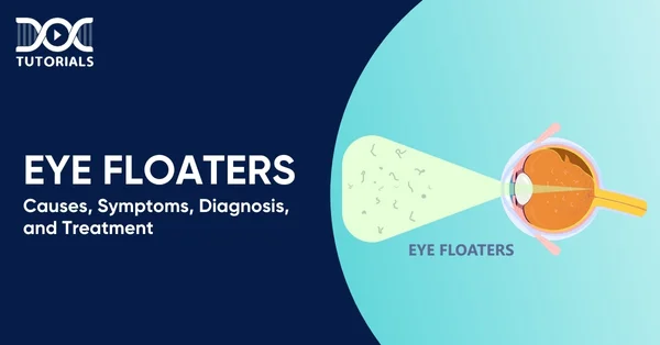 Eye Floaters