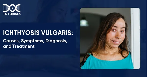 Ichthyosis Vulgaris