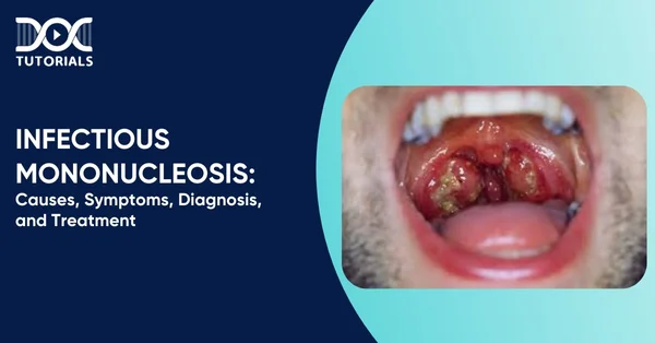 Infectious Mononucleosis