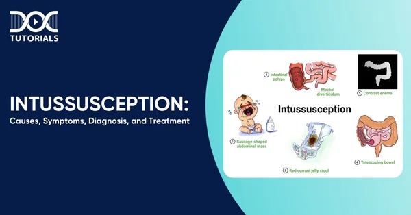 Intussusception