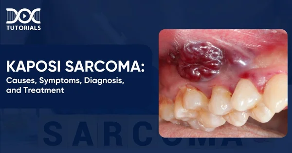 Kaposi Sarcoma