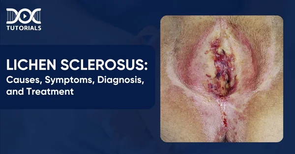 Lichen Sclerosus