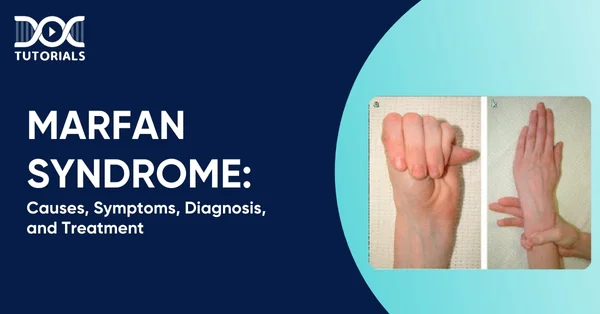 Marfan Syndrome