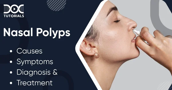 Nasal Polyps