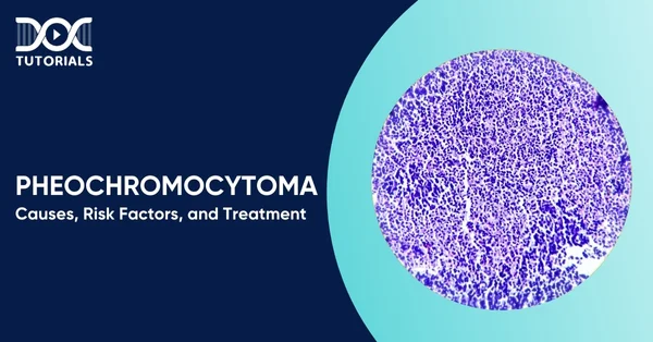 Pheochromocytoma