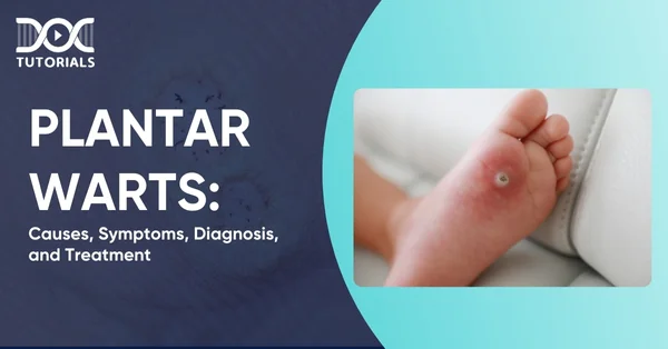 Plantar Warts
