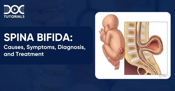 Spina Bifida