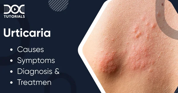 Urticaria