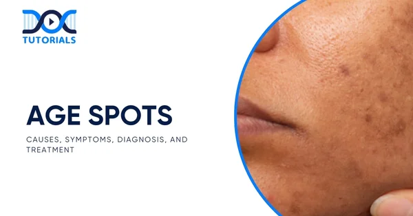 Age Spots