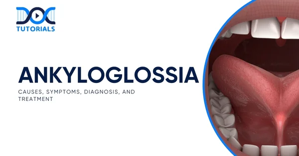 Ankyloglossia