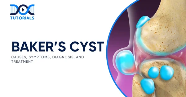 Baker’s Cyst
