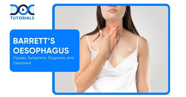 Barrett’s Oesophagus