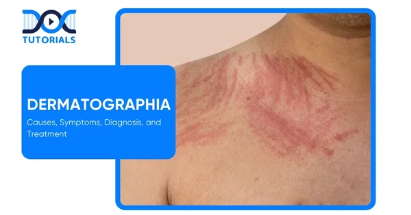 Dermatographia