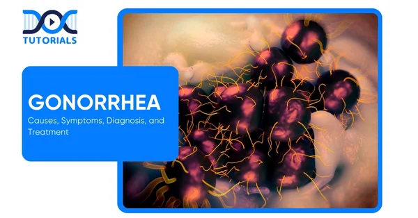 Gonorrhea