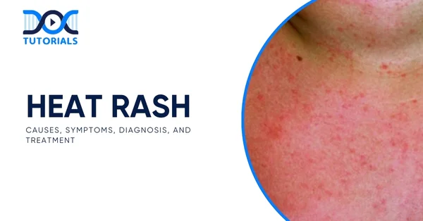 Heat Rash