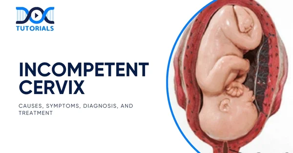 Incompetent Cervix