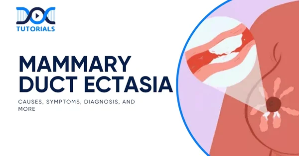 Mammary Duct Ectasia